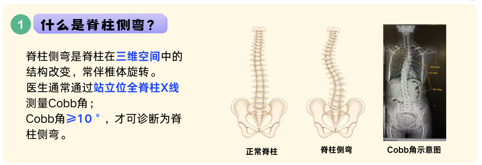 什么是青少年脊柱侧弯：三维空间结构改变和Cobb角示意图