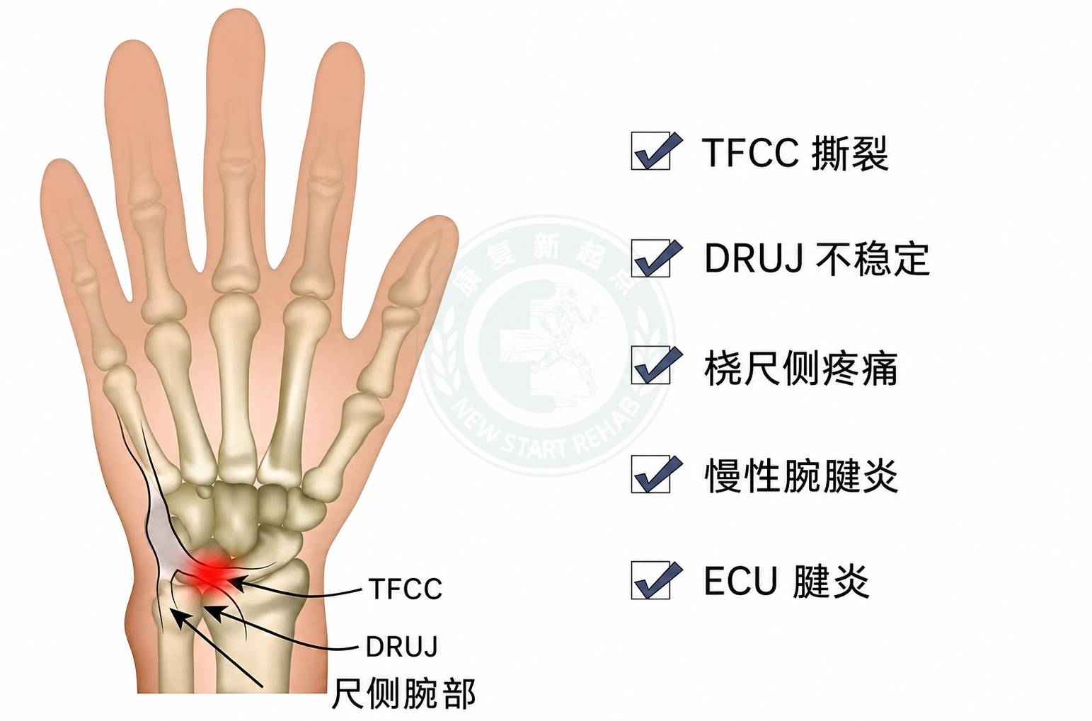 TFCC 相关症状图
