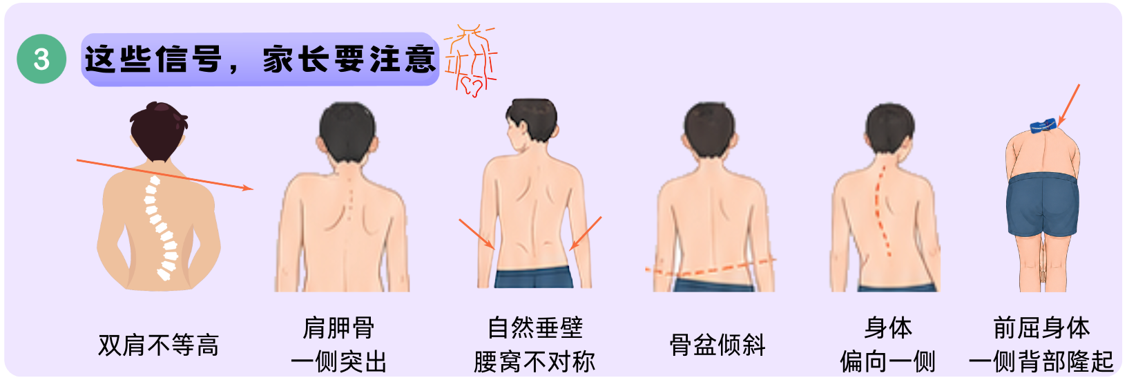 青少年脊柱侧弯家长需要注意的信号：肩不等高、肩胛骨突出、骨盆倾斜、身体偏斜、前屈异常