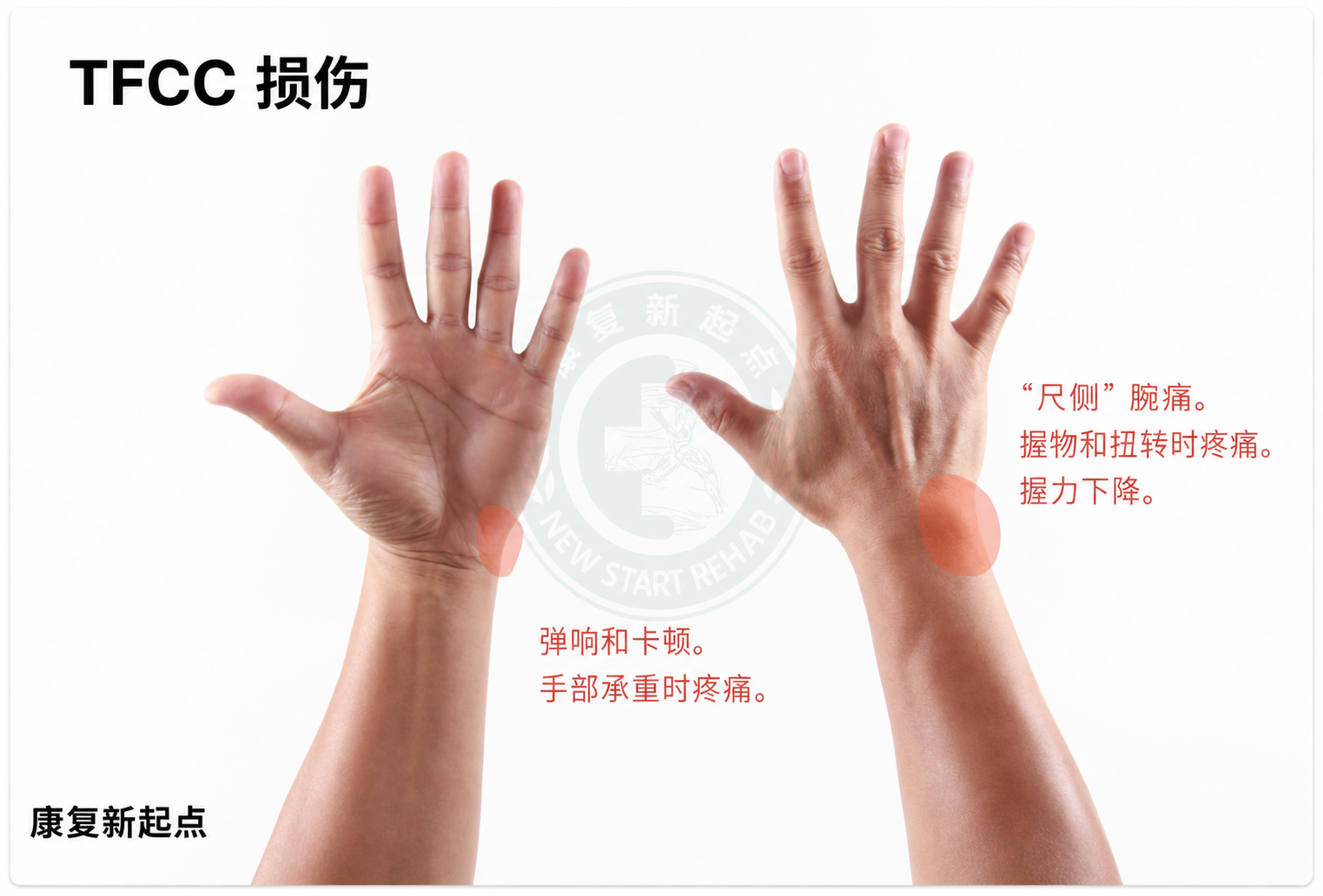 TFCC 常见症状图